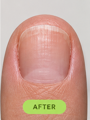 The same nail at month 1