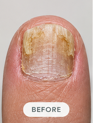 A nail before the routine, month 1