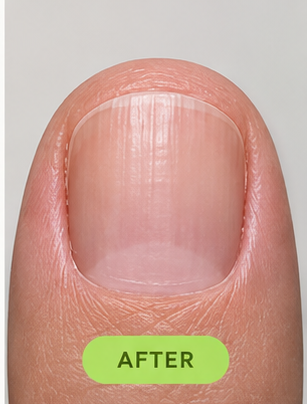 The same nail at month 2