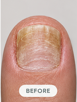 A nail before the routine, month 2