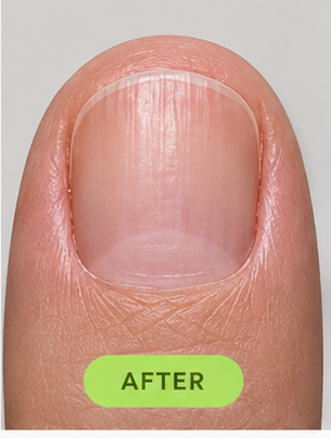 The same nail at month 3