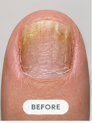 A nail before the routine, month 3
