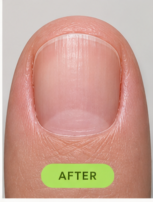 The same nail at month 4