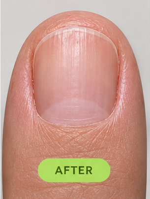 The same nail at month 5