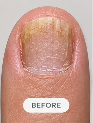 A nail before the routine, month 5