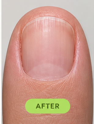 The same nail at month 6